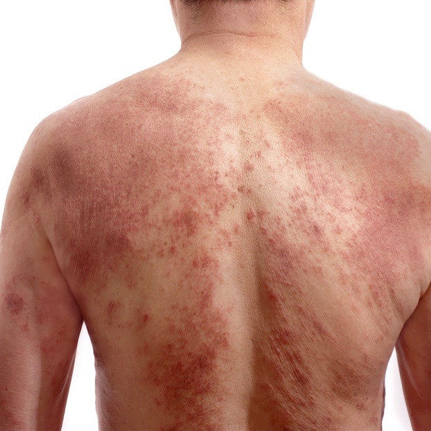 What is red skin syndrome?