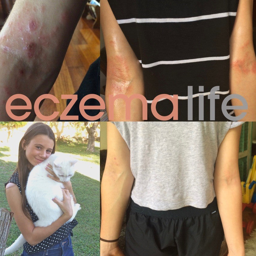 Eczema Treatments Before and After