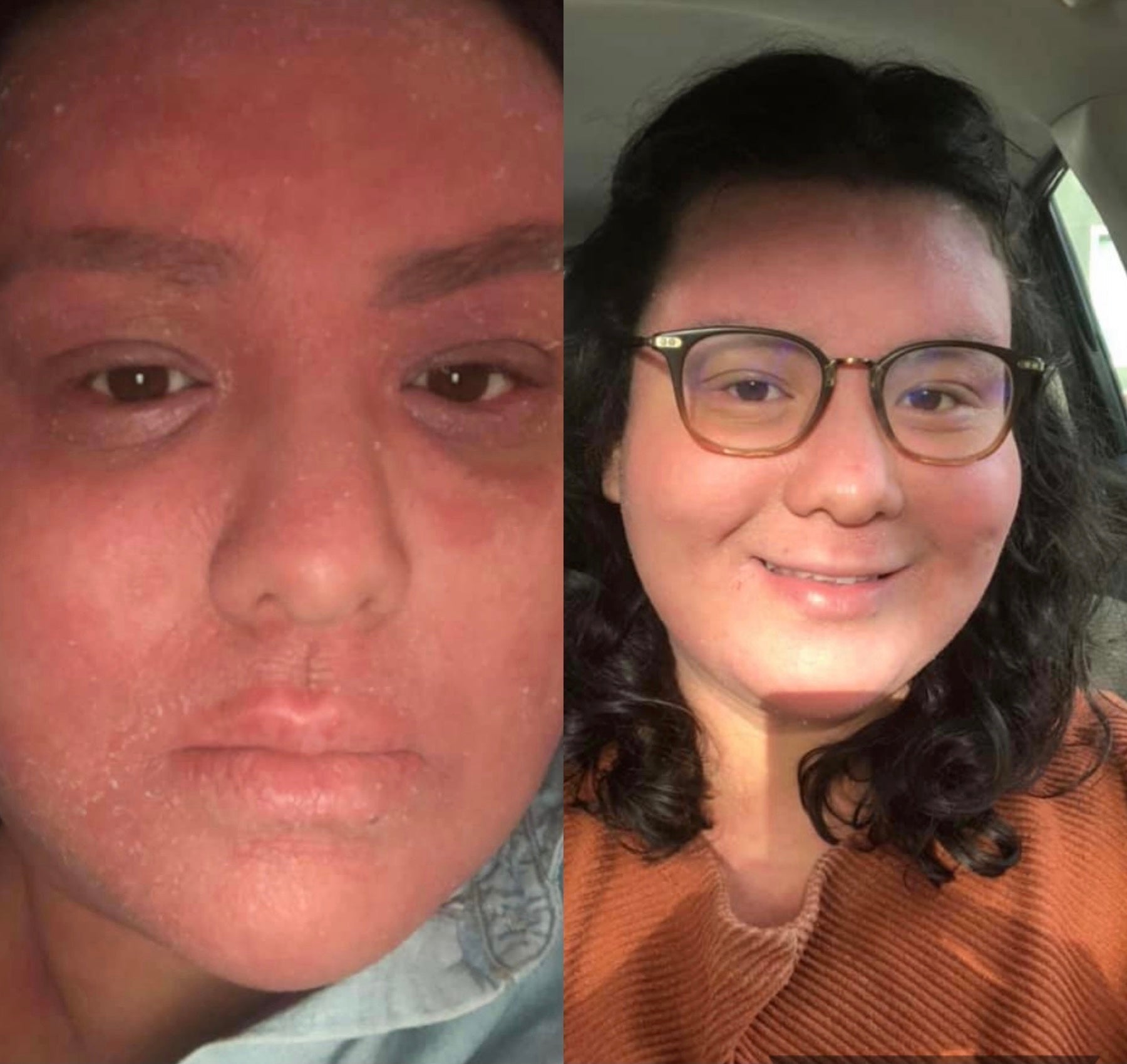 Cedar Tree Pollen Triggered Her Eczema: How Kyla Recovered