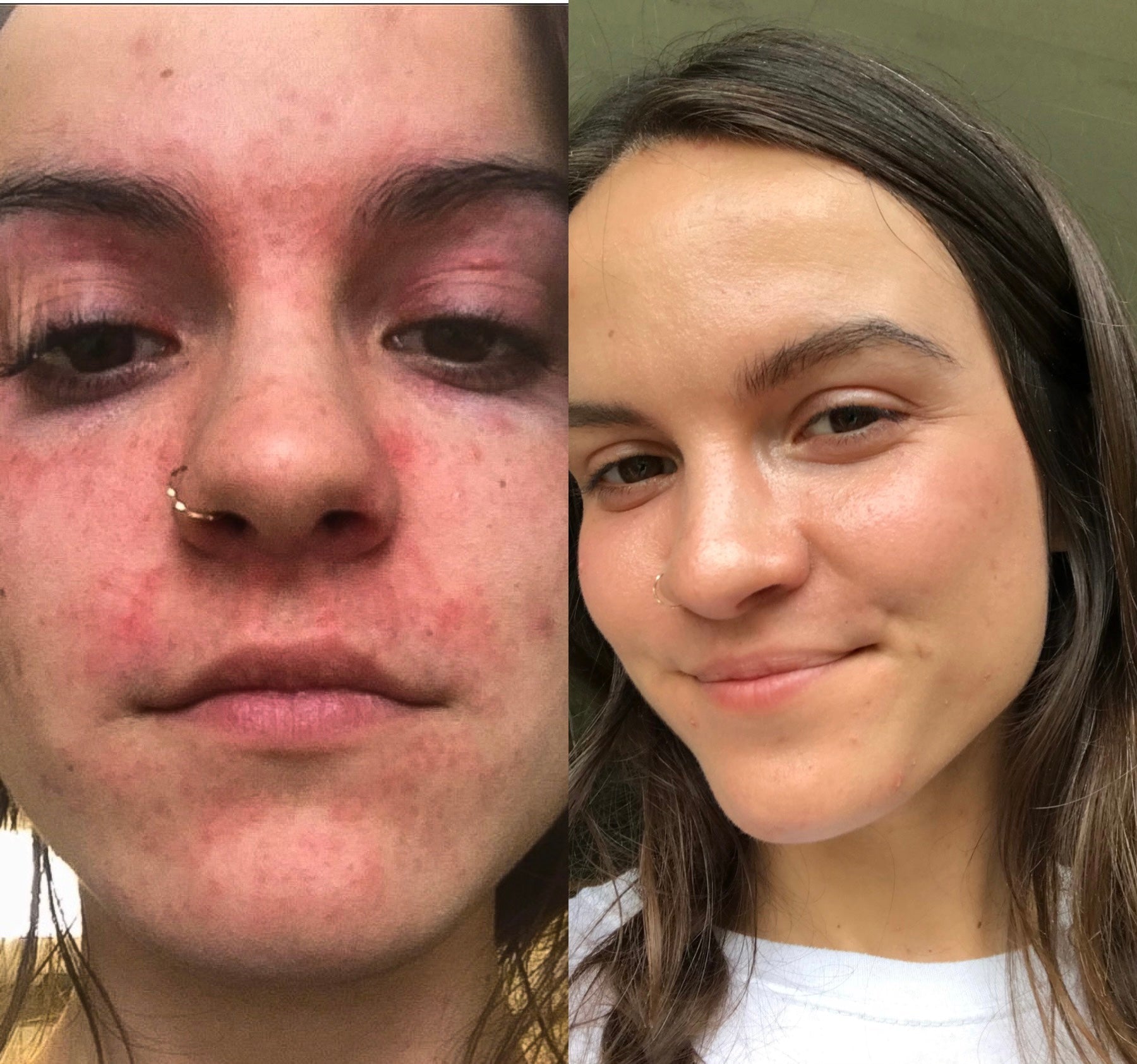 My Face Actually Looks Normal Again: Anna's Recovery From Face Eczema