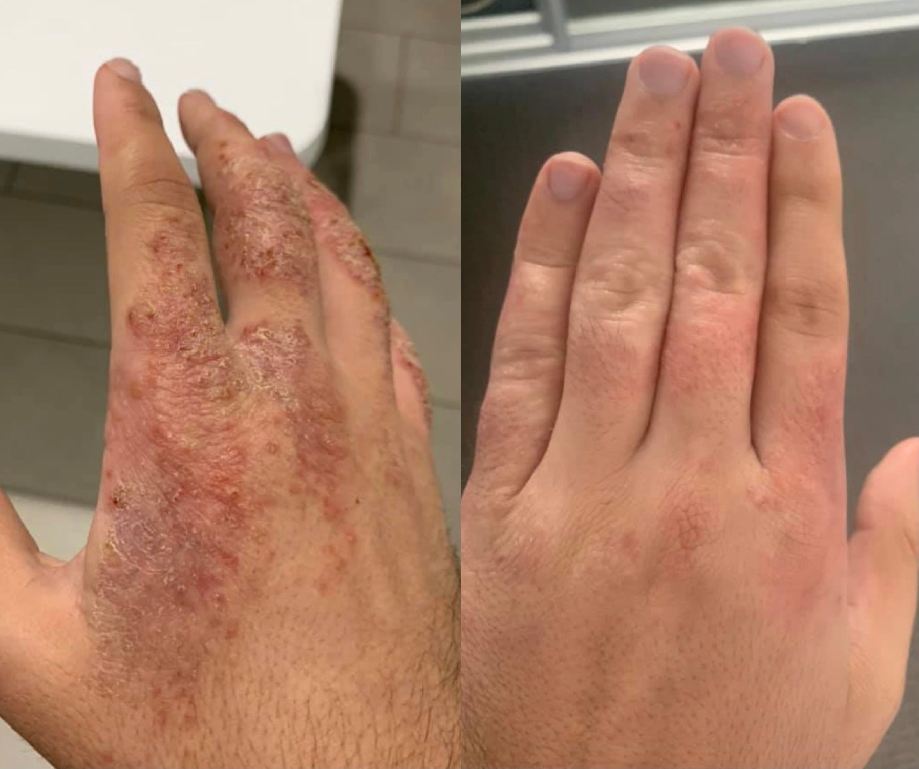 The Hand Eczema Nightmare No Cream Could Fix