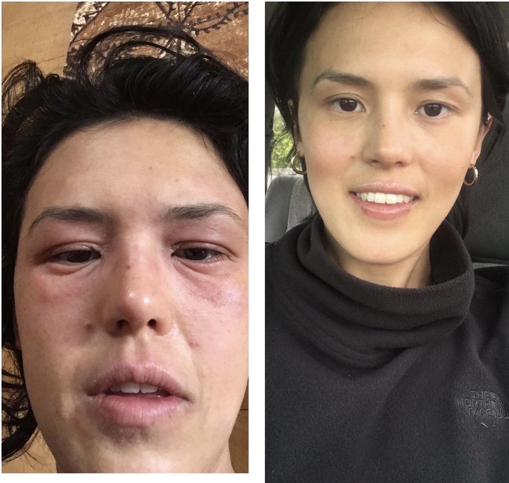 Sophie's Choice: How Changing Her Diet Changed Her Eczema