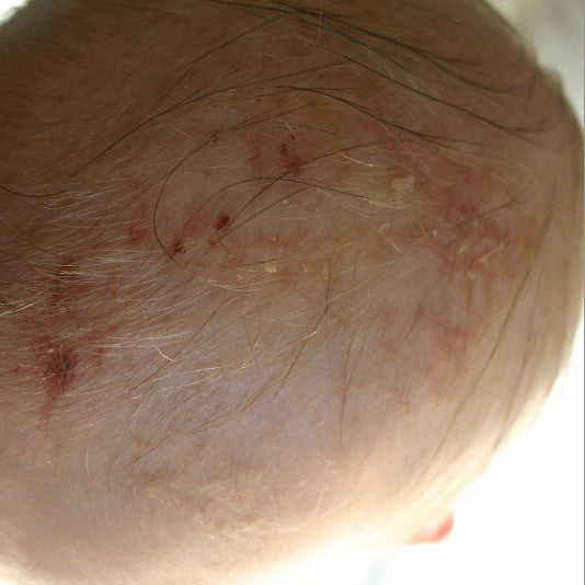 Cradle Cap Natural Remedies