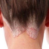 Psoriasis and eczema: what is the difference?