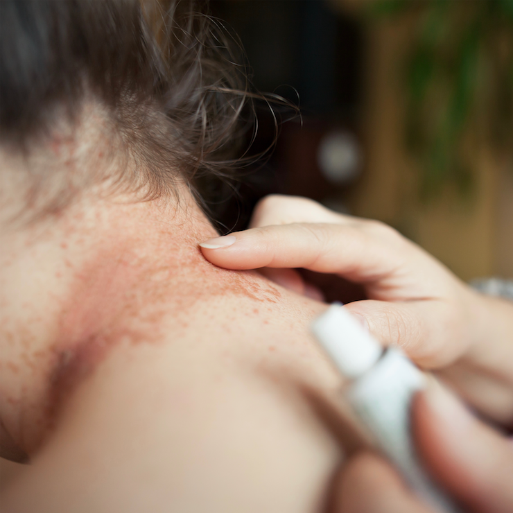 Is topical steroid withdrawal real?