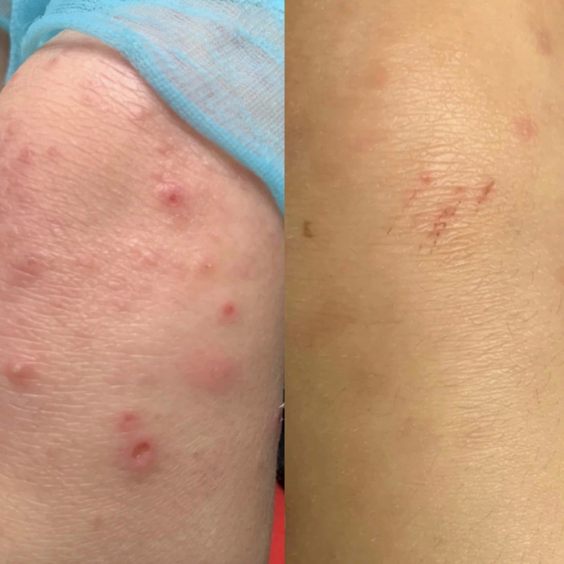 I Asked About Diet For My Child's Eczema But I Didn't Listen
