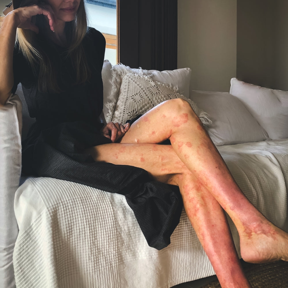 Eczema Elimination Diet: Australian Researchers Register Diet Trial for Adults With Eczema