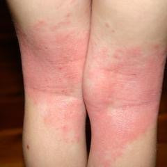 What are the different types of eczema?