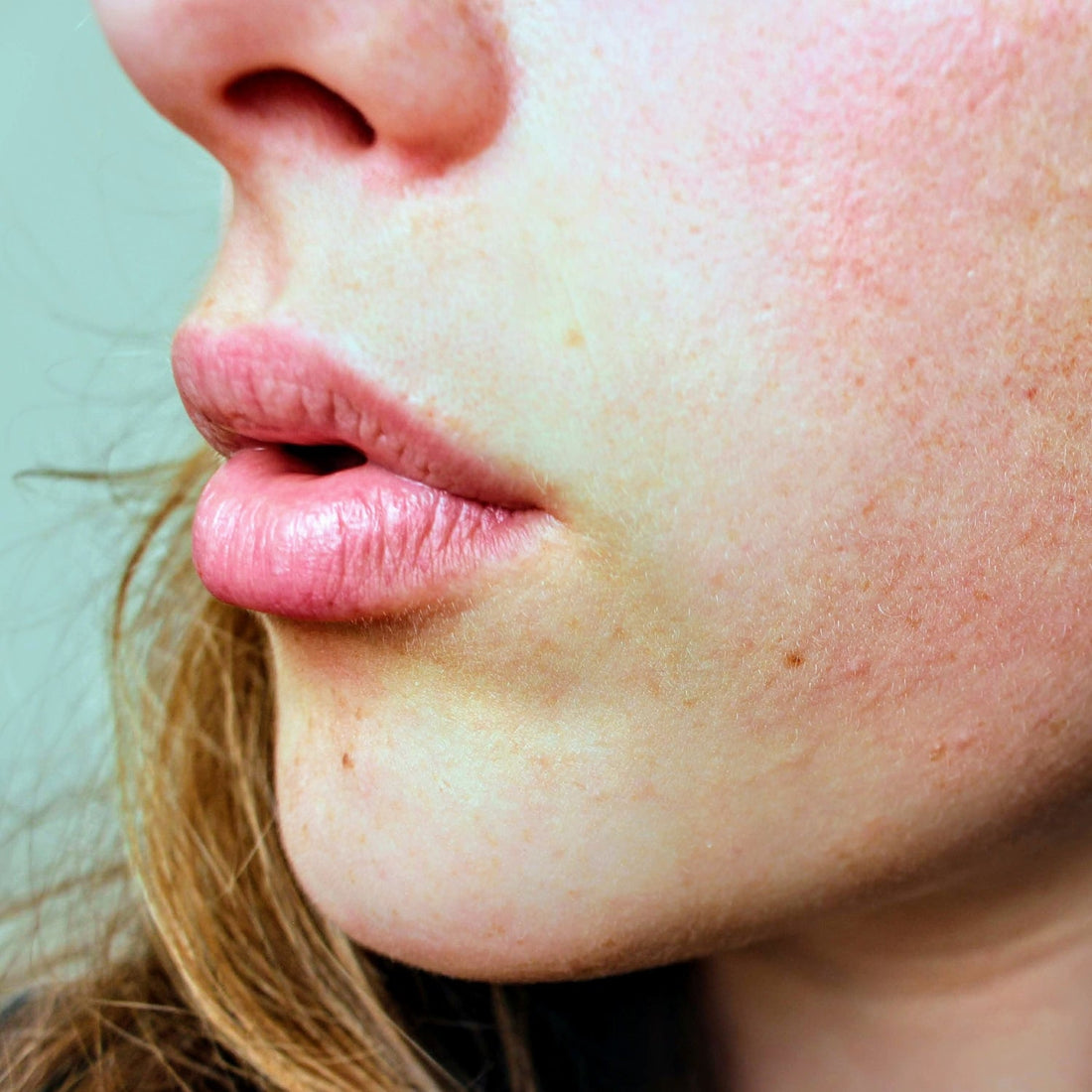 What Can I Do To Help My Eczema? A Holistic Approach