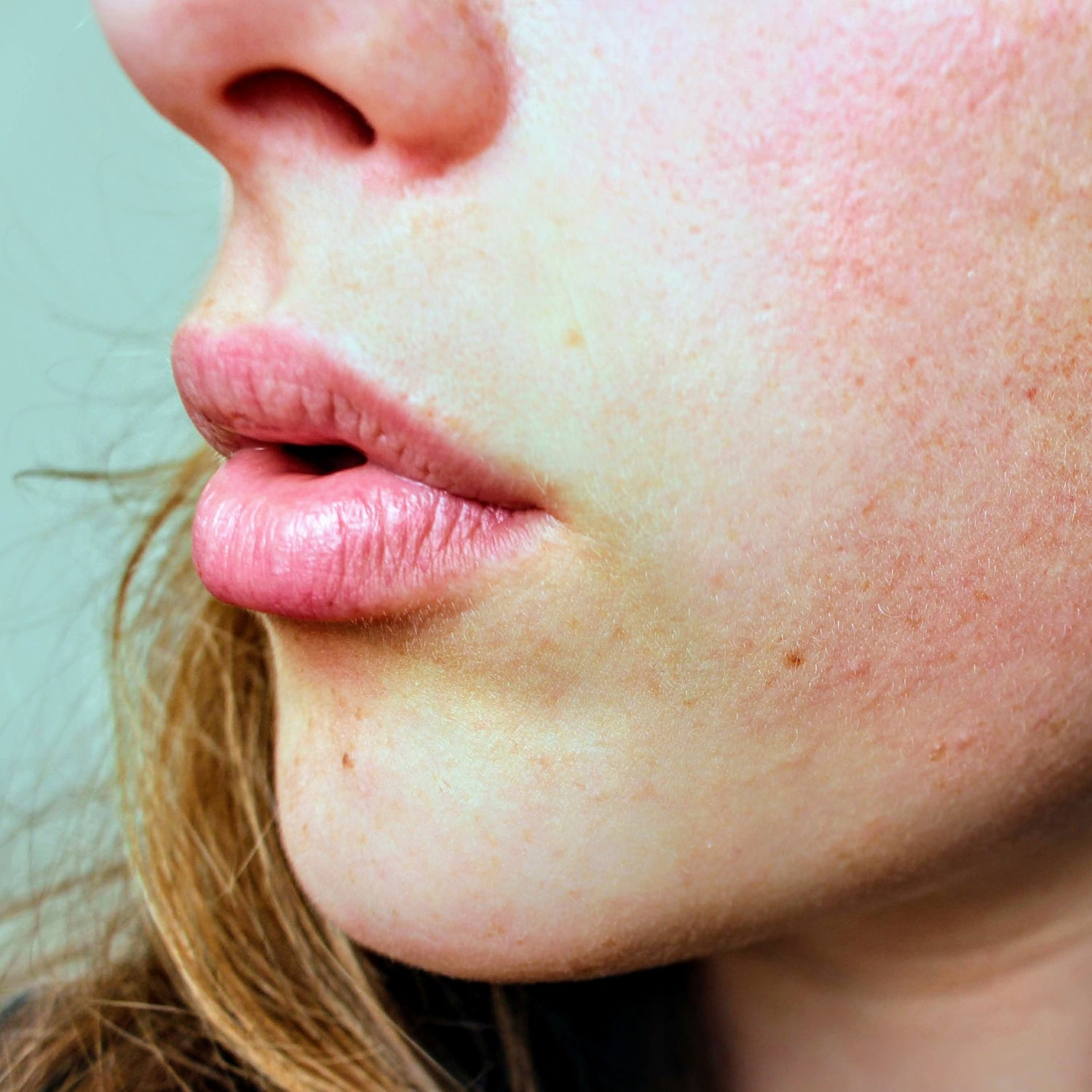 What Can I Do To Help My Eczema? A Holistic Approach
