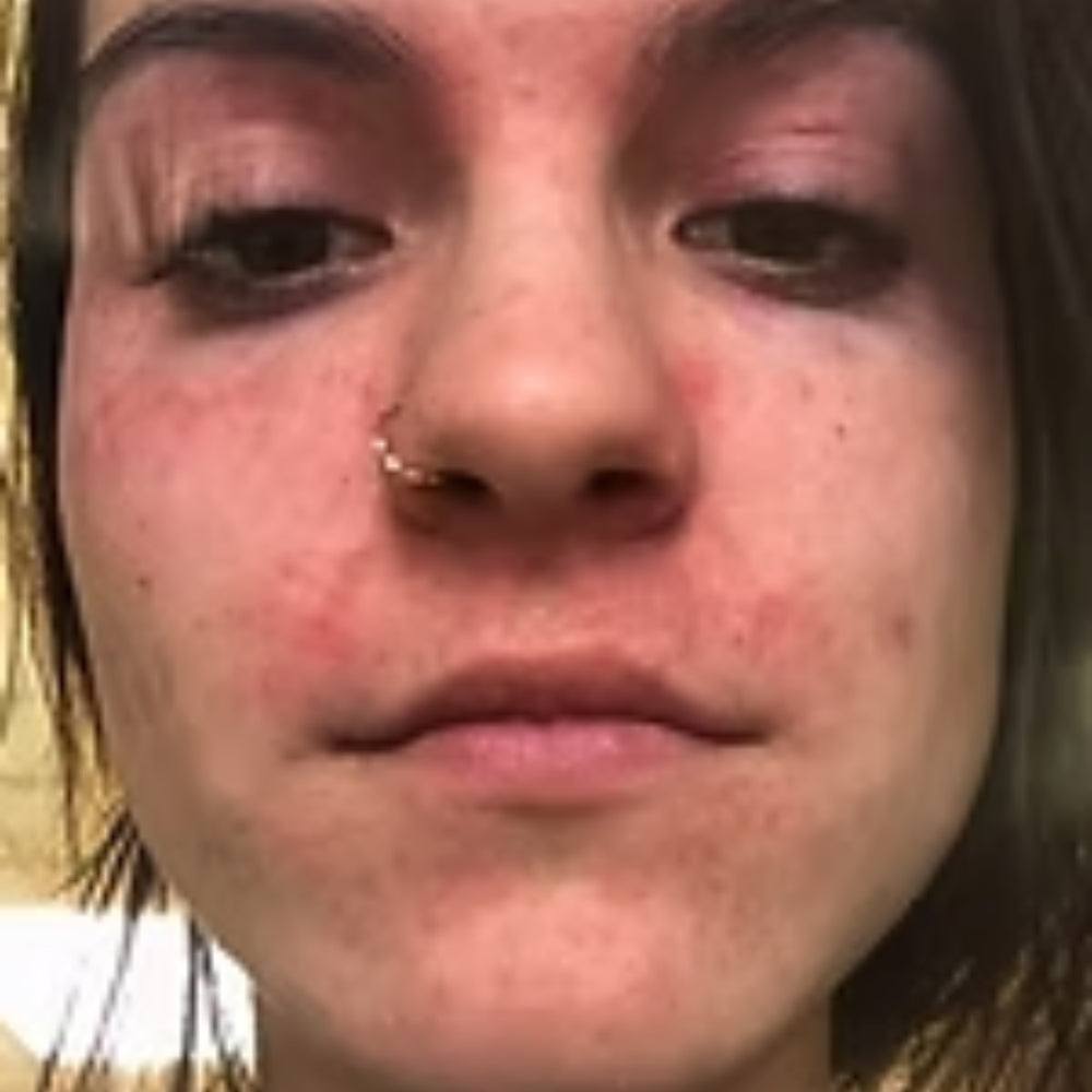 My Face Actually Looks Normal Again: Anna's Recovery From Face Eczema