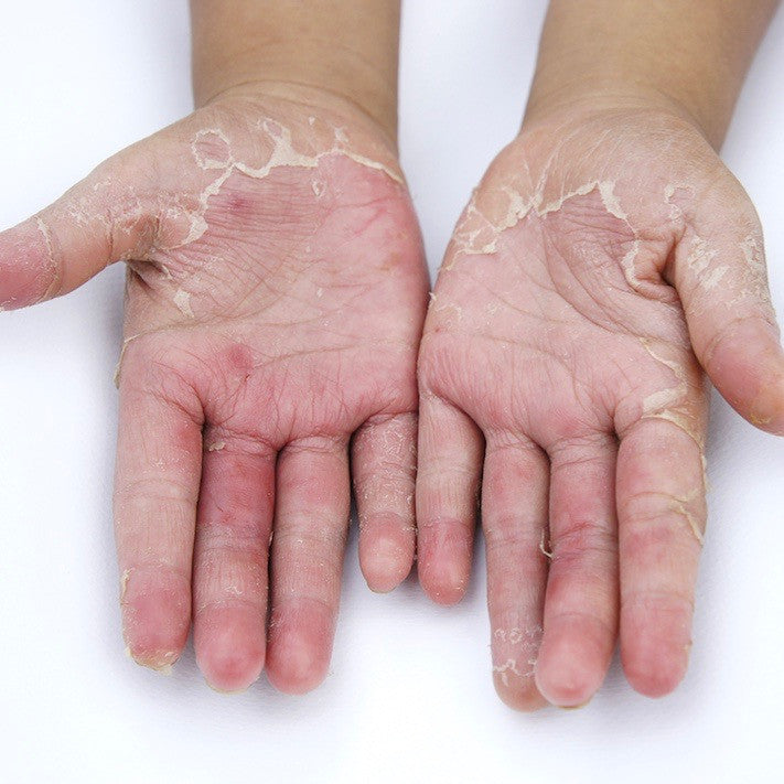 Itchy dozen signs you have topical steroid withdrawal